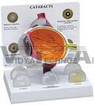 Cataract Eye Model